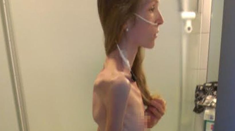 anorexia1