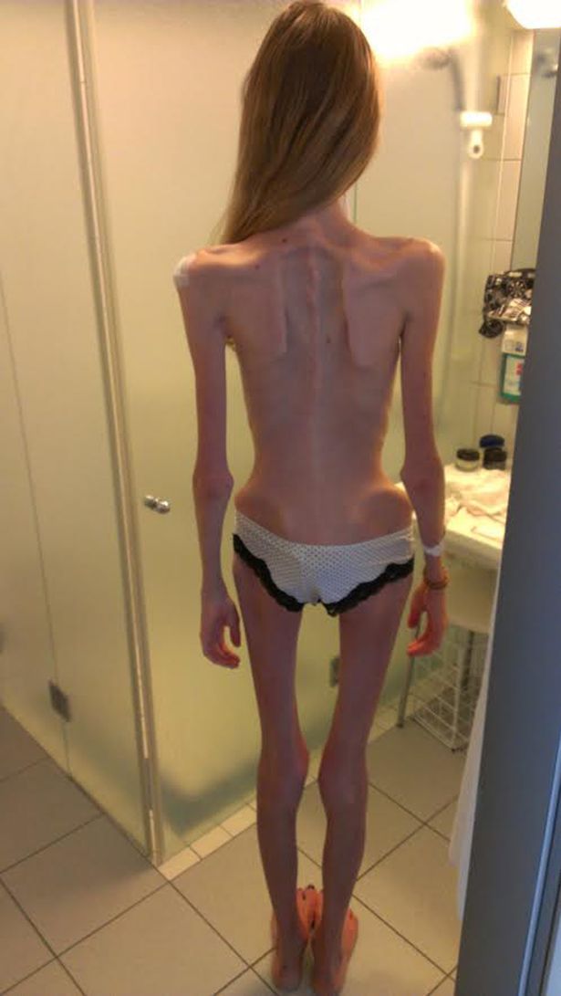 anorexia2