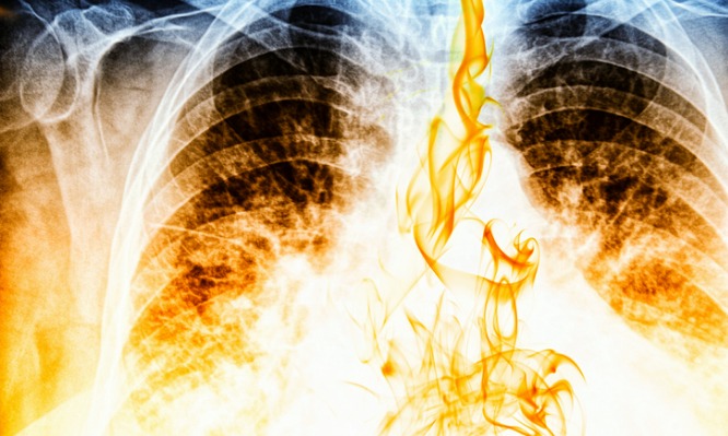 fire-visible-on-chest-xray-image-picture-id184919296