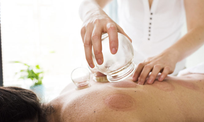 Photo of woman removing acupuncture cups from woman's back. Alternative Medicine