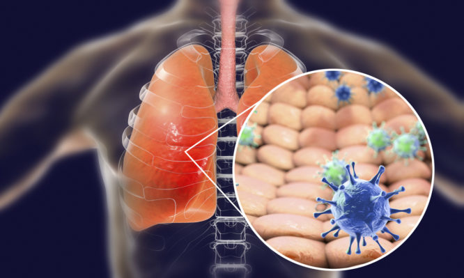 Viruses in human lungs, 3D illustration. Conceptual image for viral pneumonia, flu, MERS-CoV, SARS, Adenoviruses and other respiratory viruses