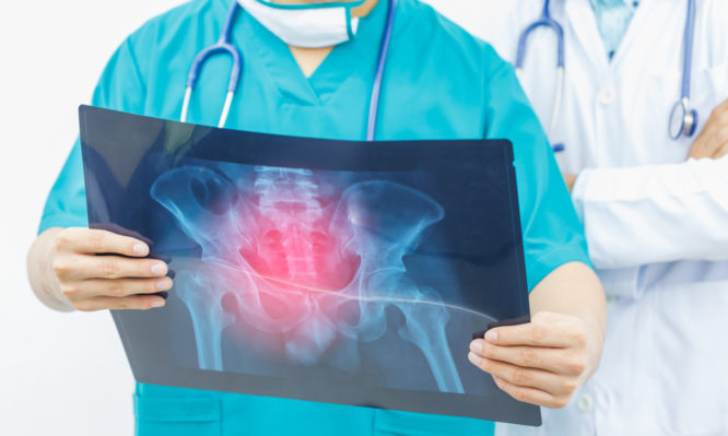 Two doctors are diagnosing the symptoms of a patient from x-ray at hip bone.