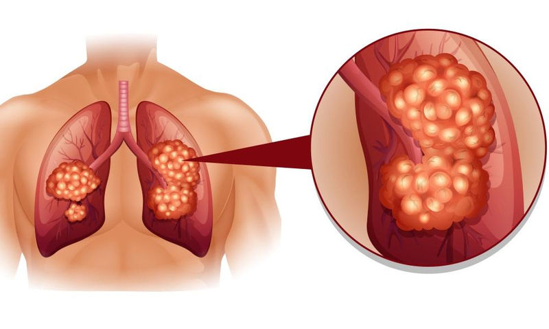 lung-cancer