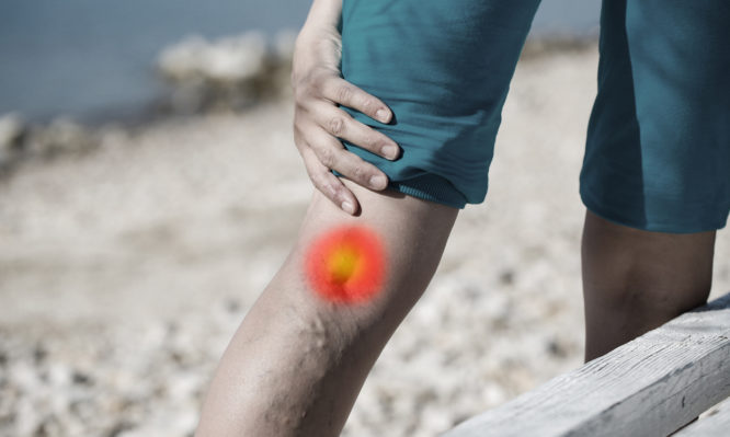 Woman touching painful varicose veins on a leg with red dot effect. Healthcare concept.