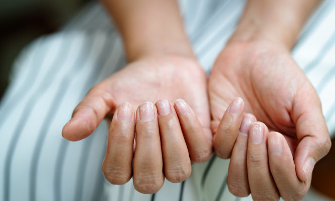 brittle damaged nails after using shellac or gel-lacquer