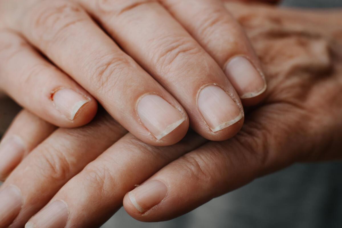 closeup-senior-caucasian-woman-s-hand-damaged-nails-dry-skin-hangnails-cuticles-skin-disease-dermatology-macro-photo-selective-focus