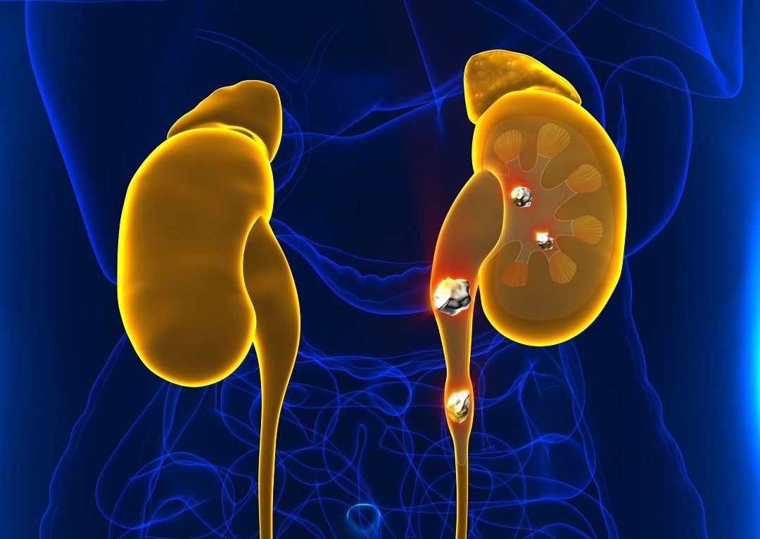 Nephrolithiasis