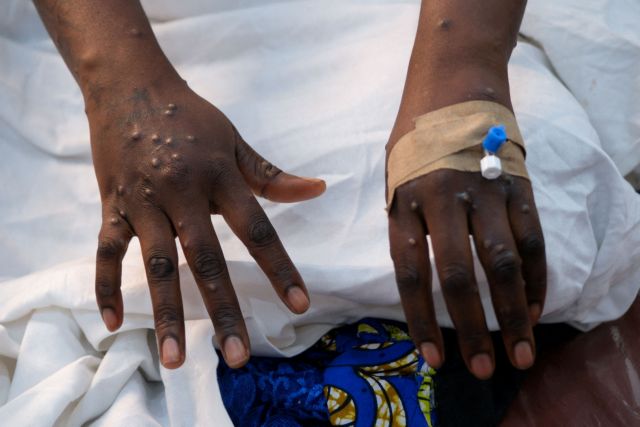 FILE PHOTO: The hands of a patient with skin rashes caused by the mpox virus are pictured at the treatment center of Vijana Hospital in Kinshasa, Democratic Republic of Congo August 30, 2024. REUTERS/Justin Makangara/File Photo